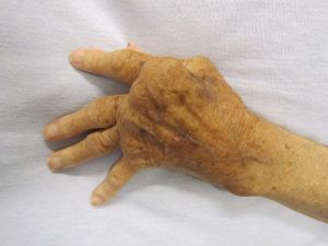 rheumatoid arthritis on a hand