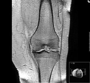 osteoarthritis at a knee