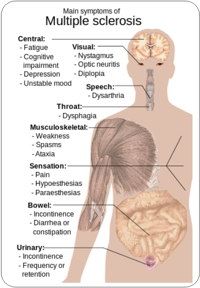 symptoms of multiple sclerosis