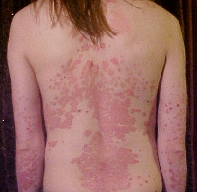 bad look of psoriasis