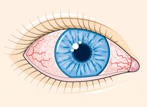 pink eye symptoms: redness