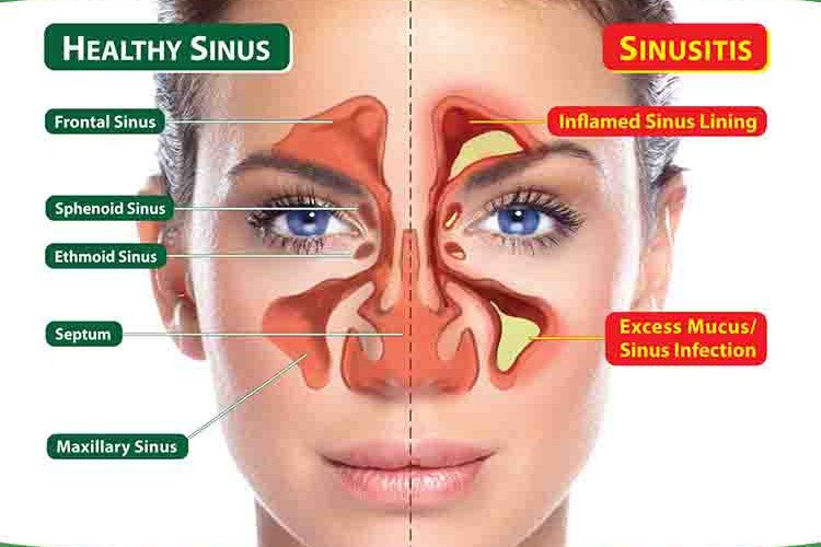 sinus inflammation