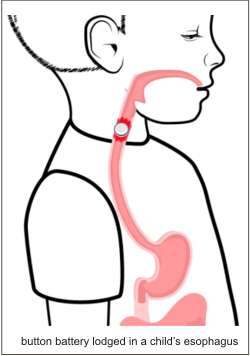 lithium battery in a child throat