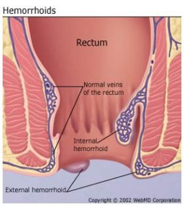 what are hemorrhoids